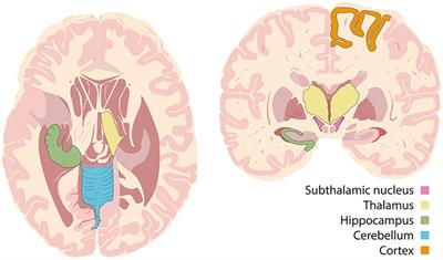 Deep Brain Stimulation and Drug-Resistant Epilepsy: A Review of the Literature